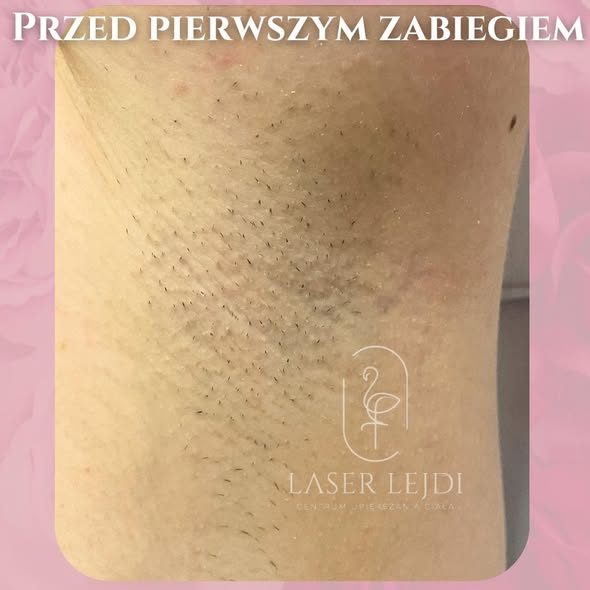 Pachy przed pierwszym zabiegiem depilacji laserowej